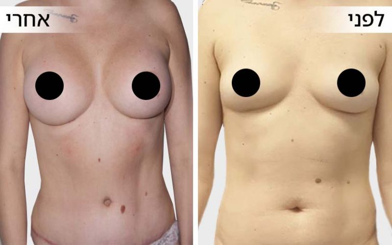 before and after_chest-11
